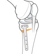 Illustration of plate and screws positioned to maintain the new bone alignment.
