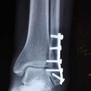X-ray of an ankle with a plate and screws