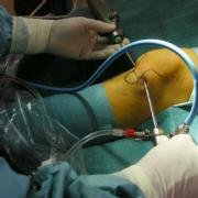 bursoscopic excision of osgood schlatter ossicle