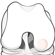 osteochondral defect