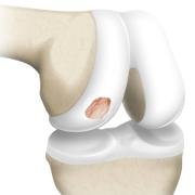 Illustration of the cartilage surface of the bent knee, to show a crater.