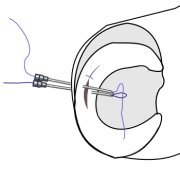 One needle allow the sure to be passed through a retractable loop in the second suture