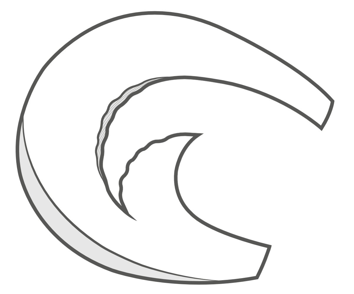 Illustration of a parrot-beak tear of the meniscus.