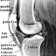 MRI image of knee bones