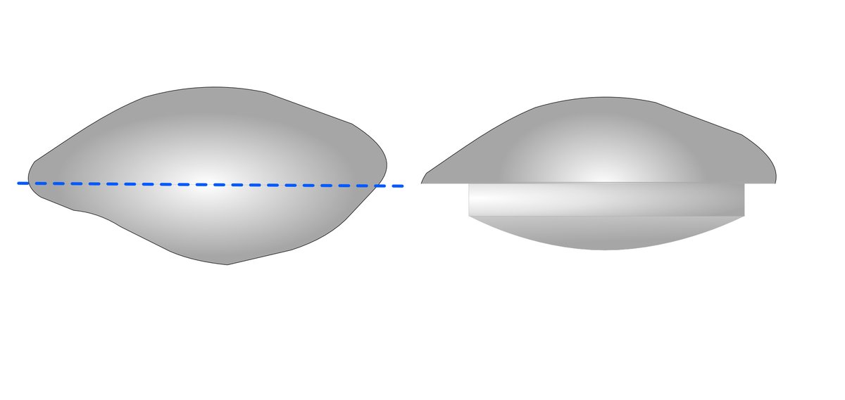 Illustration to how how the rear surface of the patella is cut away and replaced with a 'button'.
