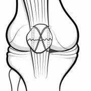 Patellar fracture with cannulated screws