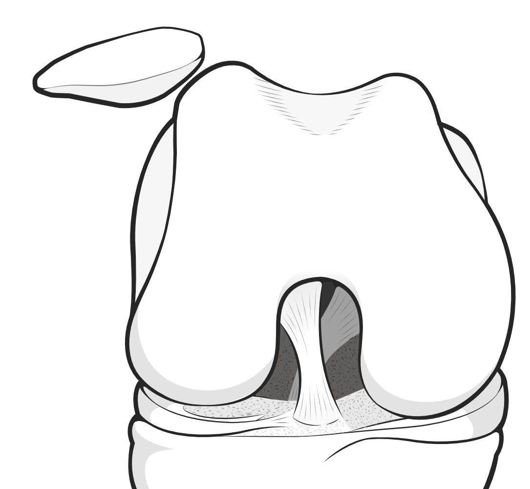 Illustration showing patella dislocated right out of its underlying groove.