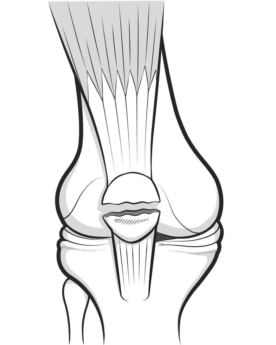 Illustration of the knee joint from the front to show a transverse fracture of the patella.