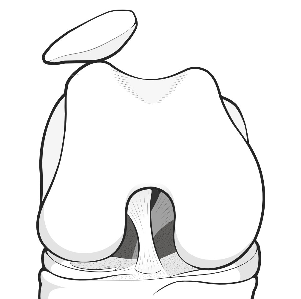Illustration showing the patella riding up its underlying groove, but still retained by its walls.