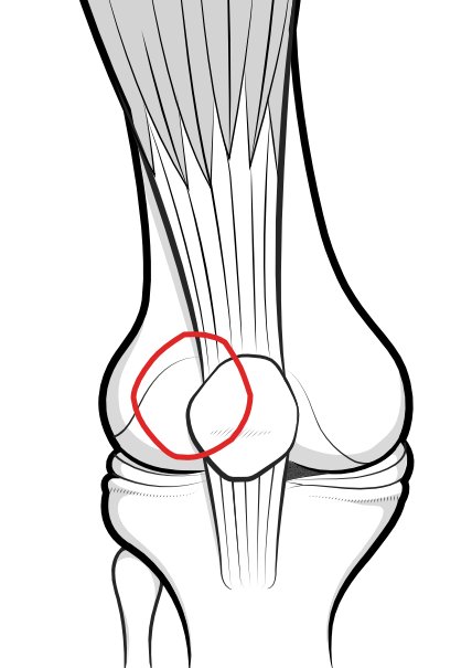 Illustration to show how the patella (outlined in red) may sublux, or slip up the walls, of the trochlear groove.