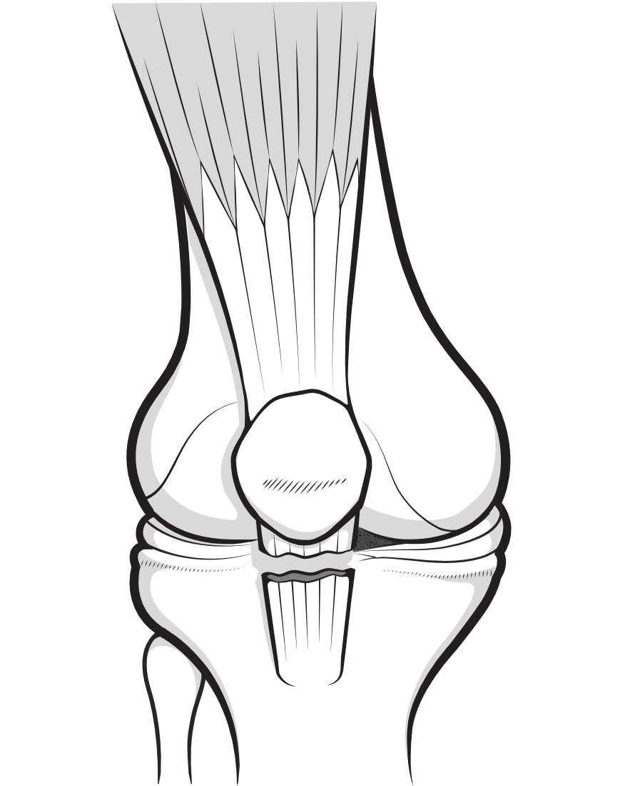 Illustration of the patella to show a rupture of the patellar tendon below it.