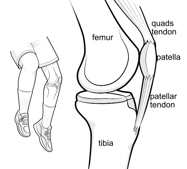 Illustration of a jumping patient, with an inset showing the knee bones from the side, and how the patella is embedded in the patellar tendon.
