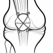 tension band wiring of fractured patella