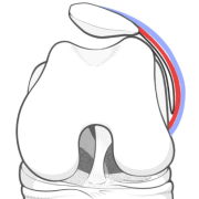 patellar tilt