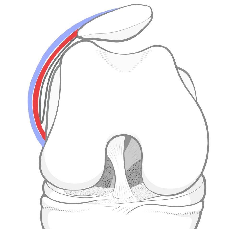 Illustration of how a tight lateral retinaculum can cause patellar tilt.