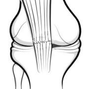 patellectomy-post.jpg