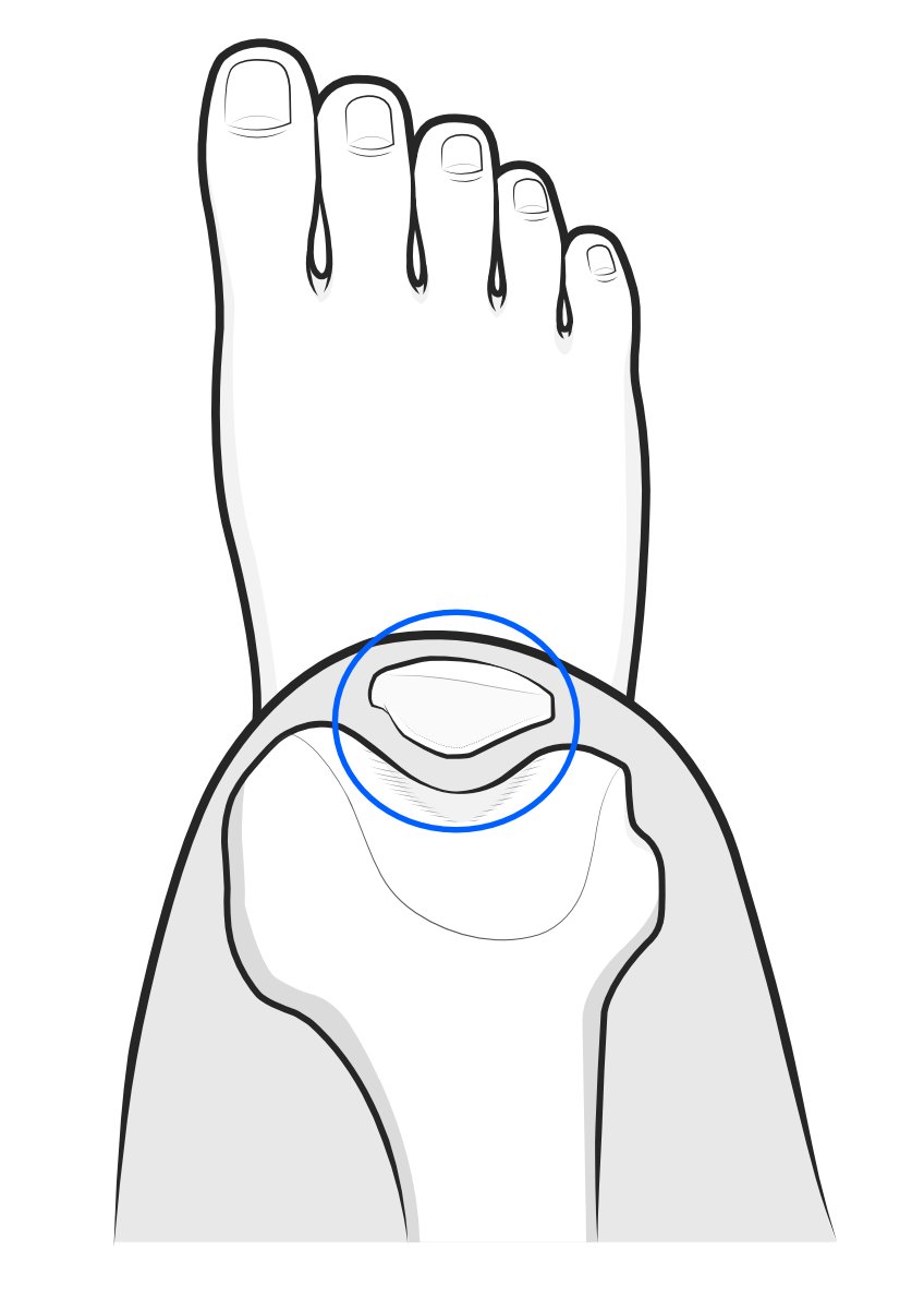 Illustration of skyline view of patellofemoral joint.