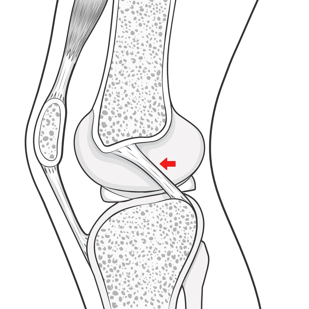 Side view of the inside of the knee joint, to show the normal situation of the PCL.