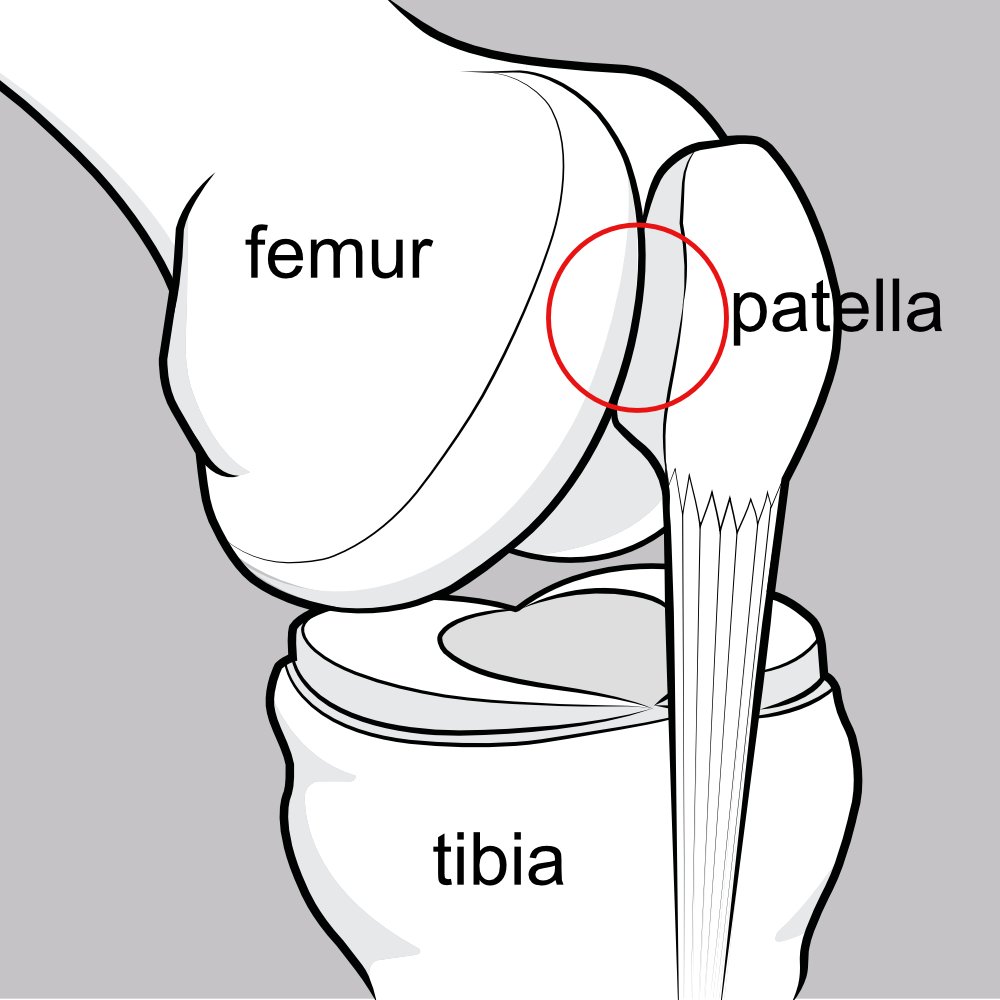 An illustration showing an oblique view of the knee joint, particularly illustrating how the patella snugs into its underlying groove on the femur.