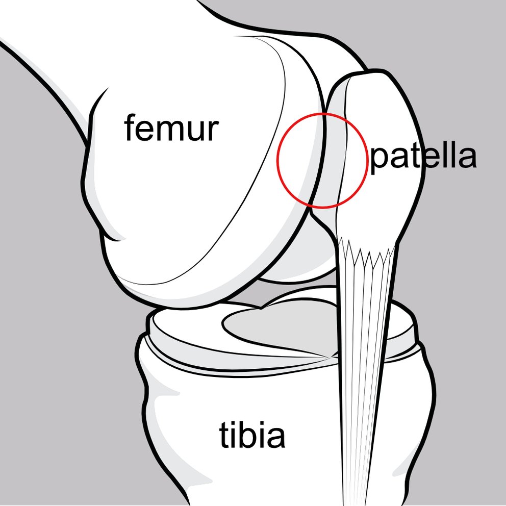 An illustration showing an oblique view of the knee joint, particularly illustrating how the patella snugs into its underlying groove on the femur.
