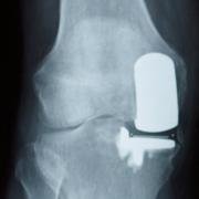 X-ray showing a partial knee replacement