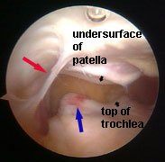 bowstringing plica