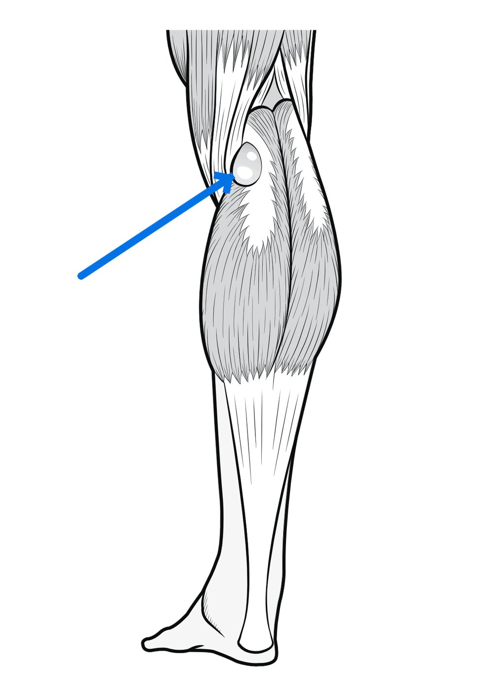 popliteal-bakers-cyst02