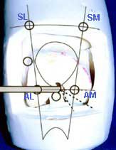 arthroscopy portals