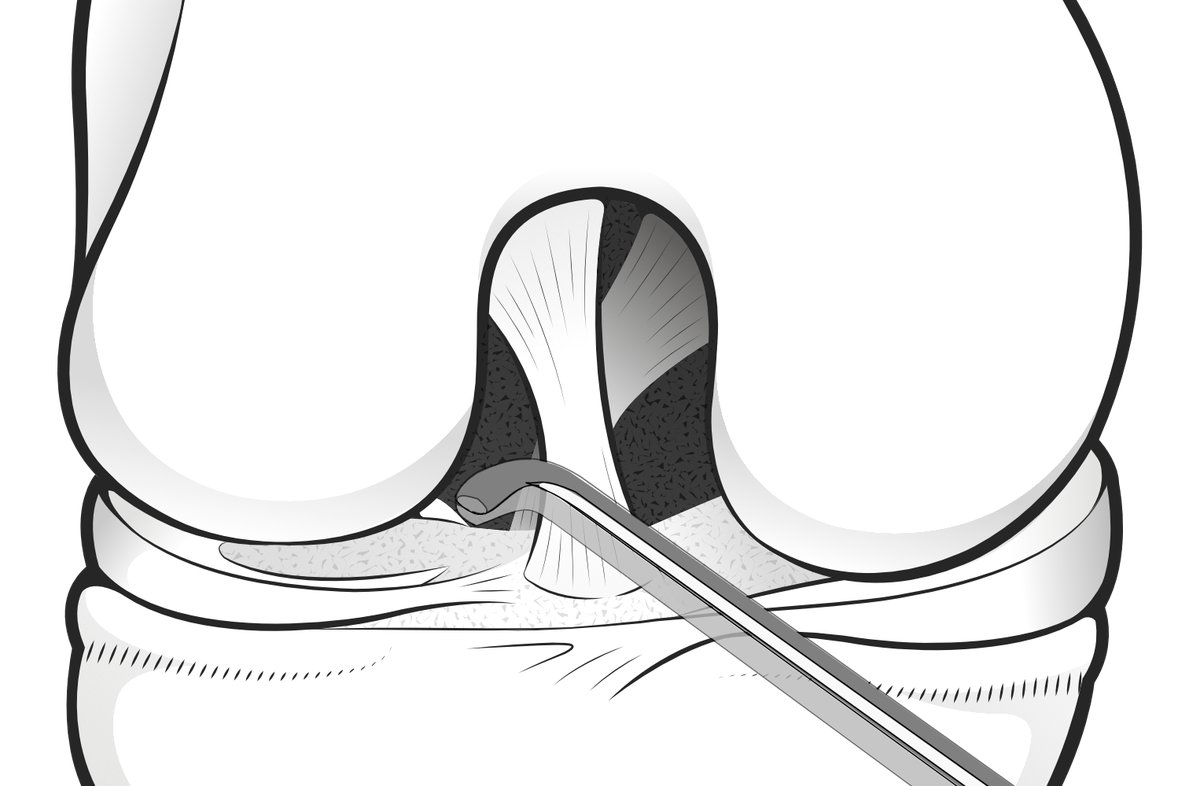 Illustration of surgeon probing the meniscal root at the back of the ky.nee during arthroscop