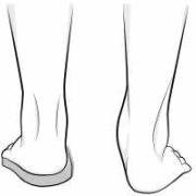 Passive correction via a shoe insert.