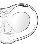 ramp lesion of medial meniscus