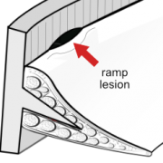 ramp lesion of menisco-capsular junction