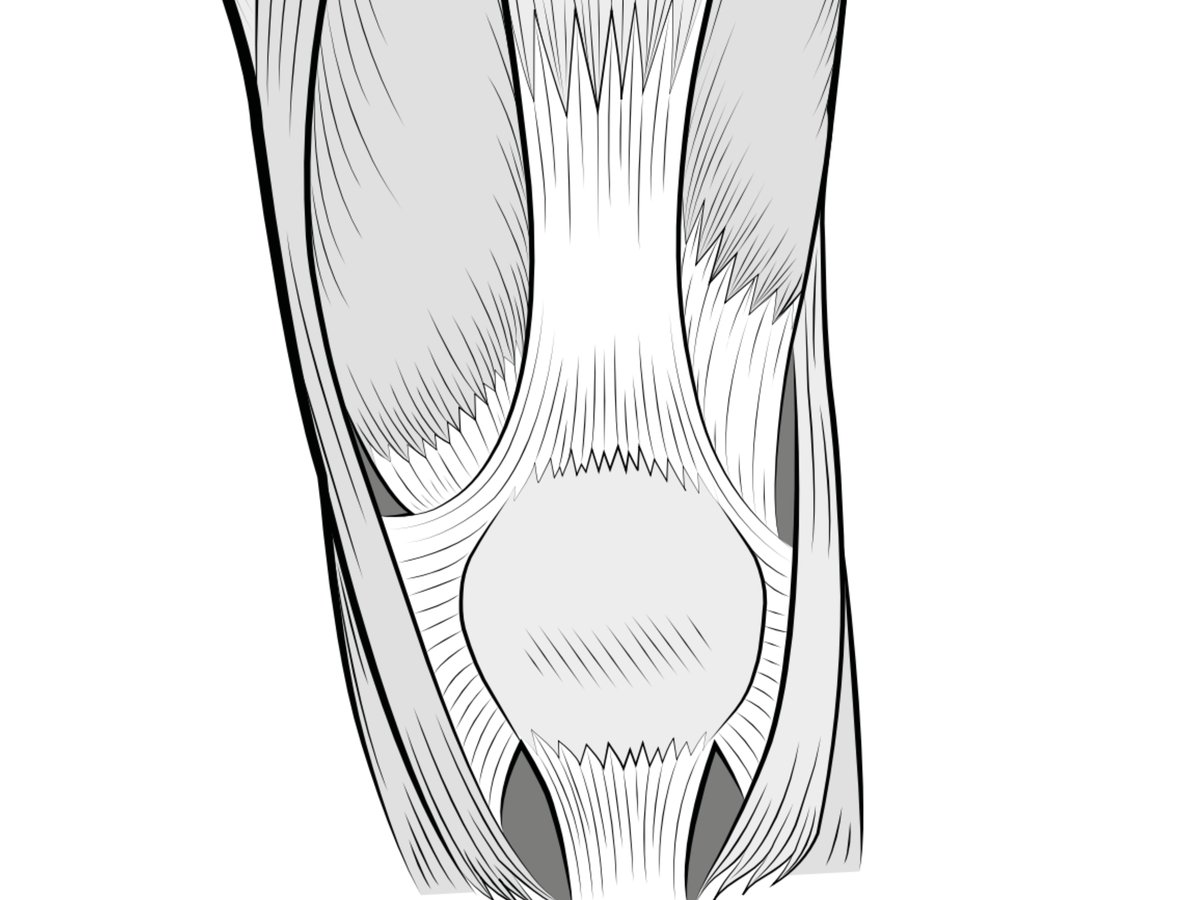 Illustration to show how the patella is supported within its underlying groove by a network of retinacular tissue.