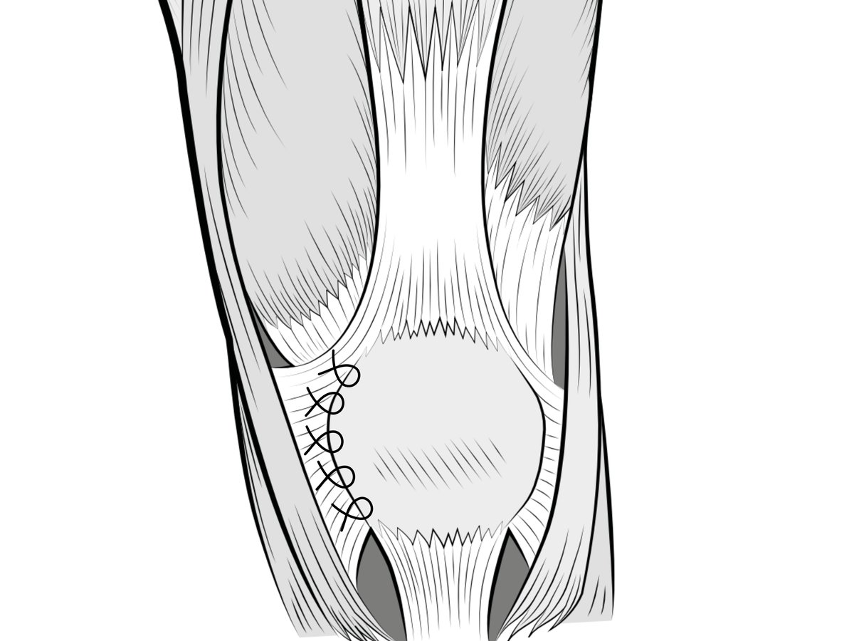retinaculum6