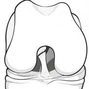 Illustration of Sherman Type 2 tear of the anterior cruciate ligament.