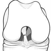 Illustration of the front of the knee, showing a tear through the substance of the anterior cruciate ligament.