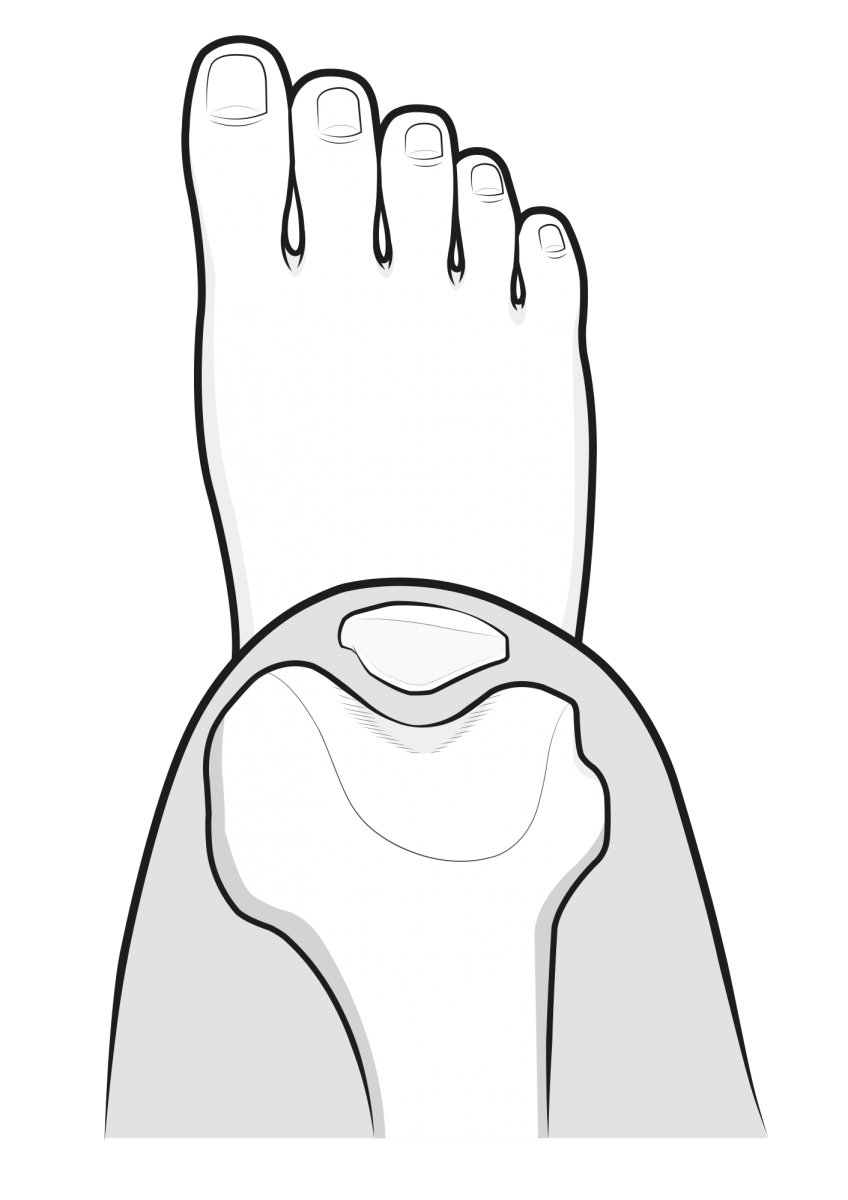 Illustration of the patellofemoral joint, as if the patient were seated and looking down at their right knee.