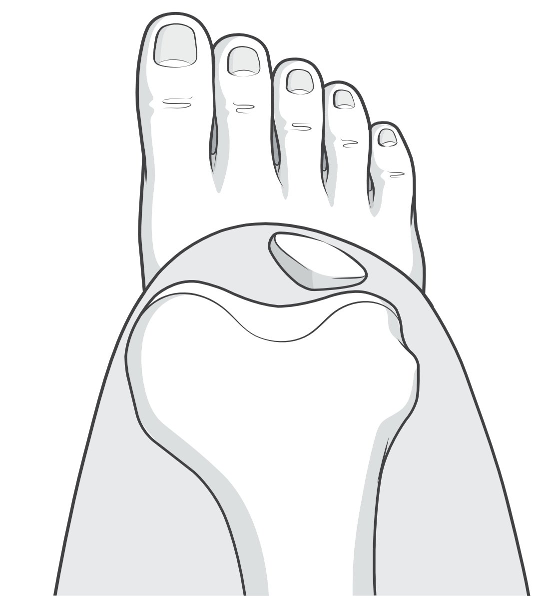 Illustration looking down at one's knee, to show the position of the patella during a subluxation event.