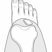 subluxation.jpg