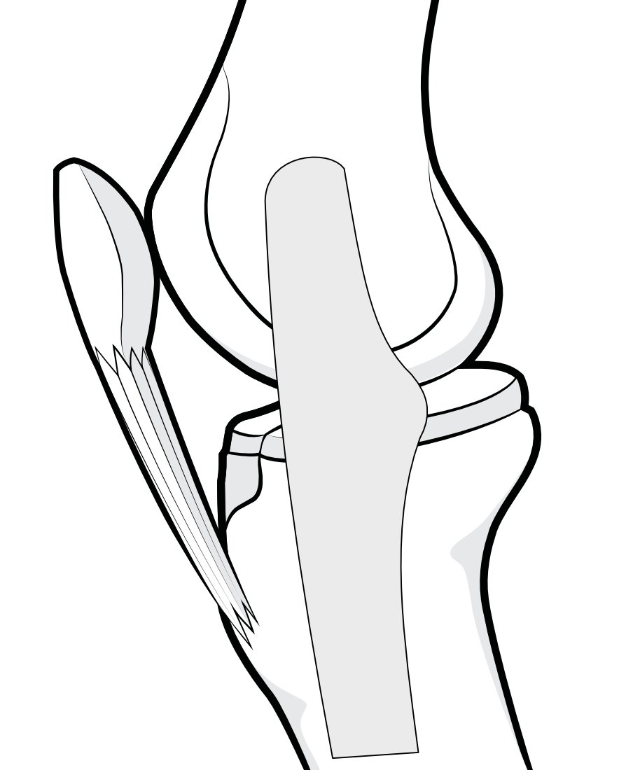 Illustration of the medial side of the knee to show the medial collateral ligament.