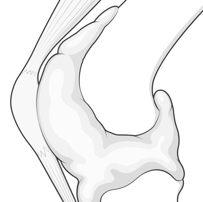 swollen-capsule.png