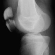 Lateral X-ray to show a transverse fracture of the patella.