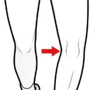 varus thrust on walking
