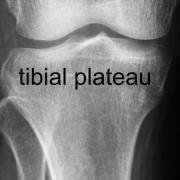 tibial plateau