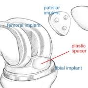 components of a total knee replacement