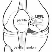 Illustration of unstable patella due to a torn MPFL.
