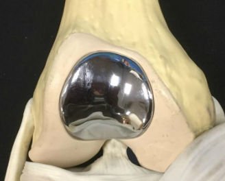trochlear-implant_02_328x264.jpg
