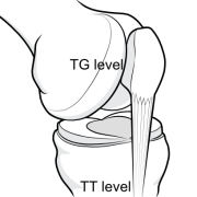 TT-TG distance