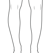 varus legs